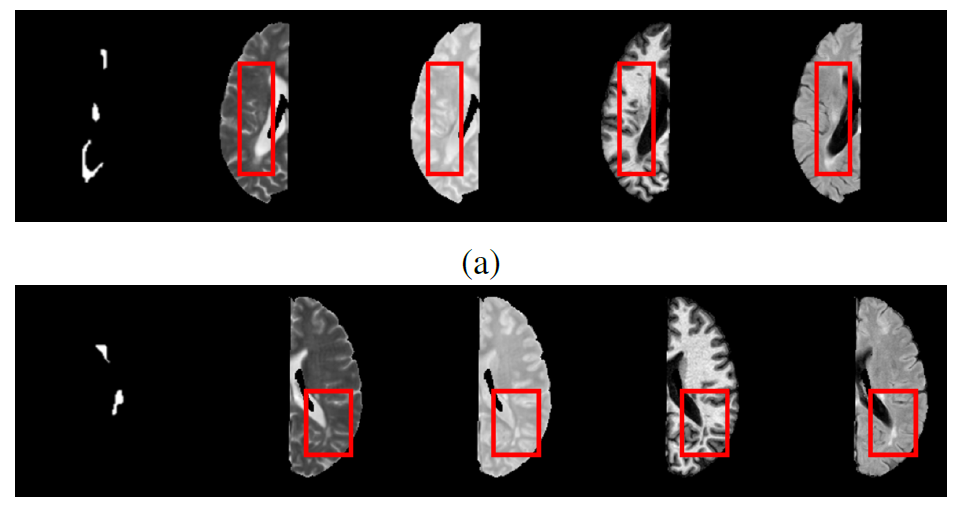 Brain parcellation in multiple sclerosis lesion segmentation