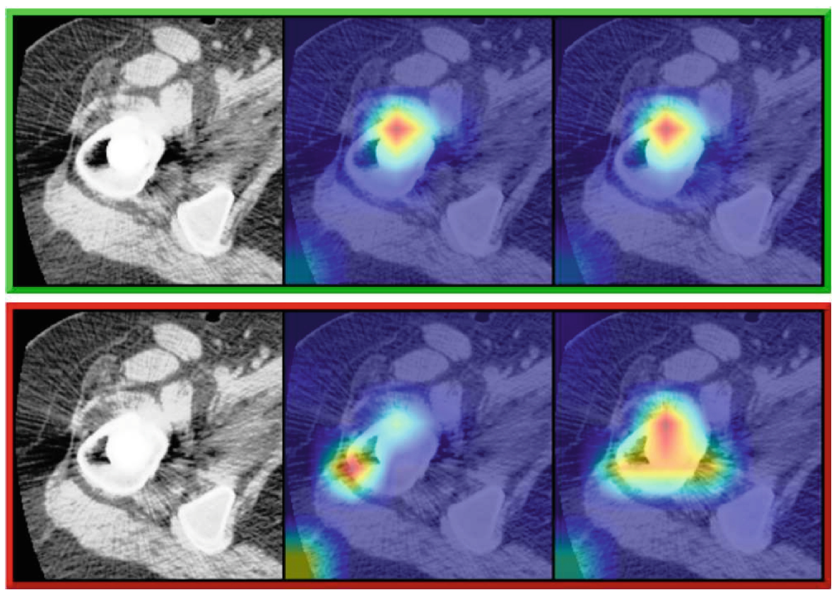 Periprosthetic joint infection detection from CT